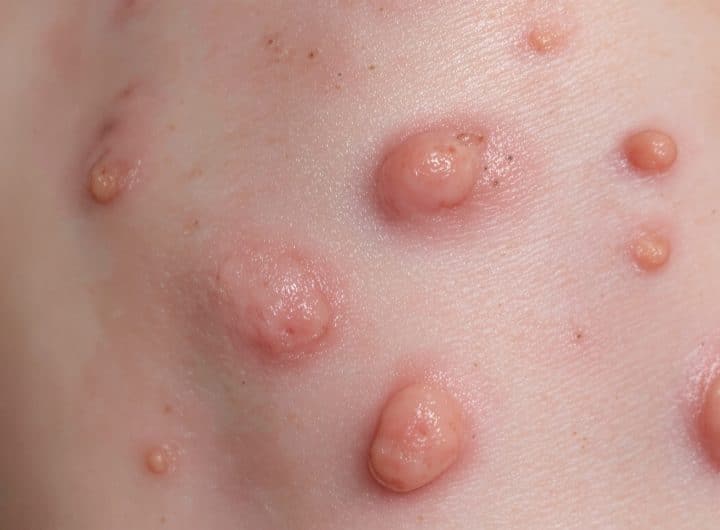 découvrez les principaux symptômes de la variole du singe (mpox), comment reconnaître les éruptions cutanées caractéristiques et consultez des images explicatives pour mieux comprendre cette maladie émergente.